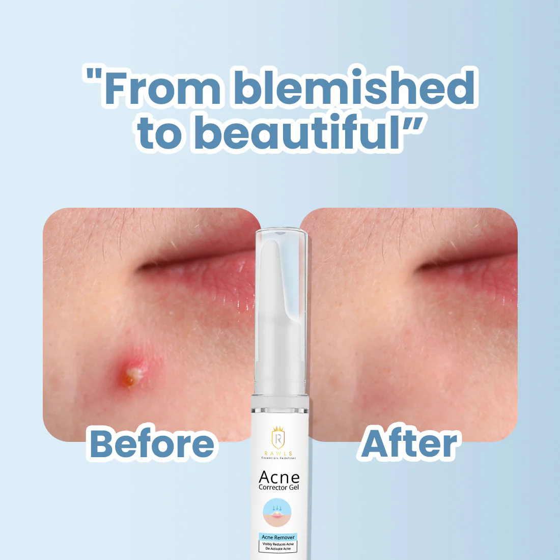 Acne Corrector Face Gel - Acne Minimizing Gel for Oily & Sensitive Skin - 10 ml - Image 5