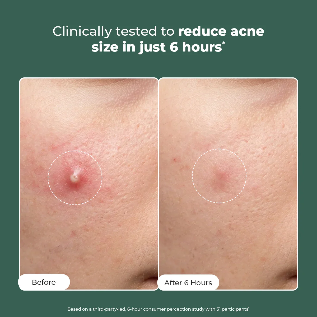 Acne Spot Corrector Gel | 15 ml | HP - Image 2