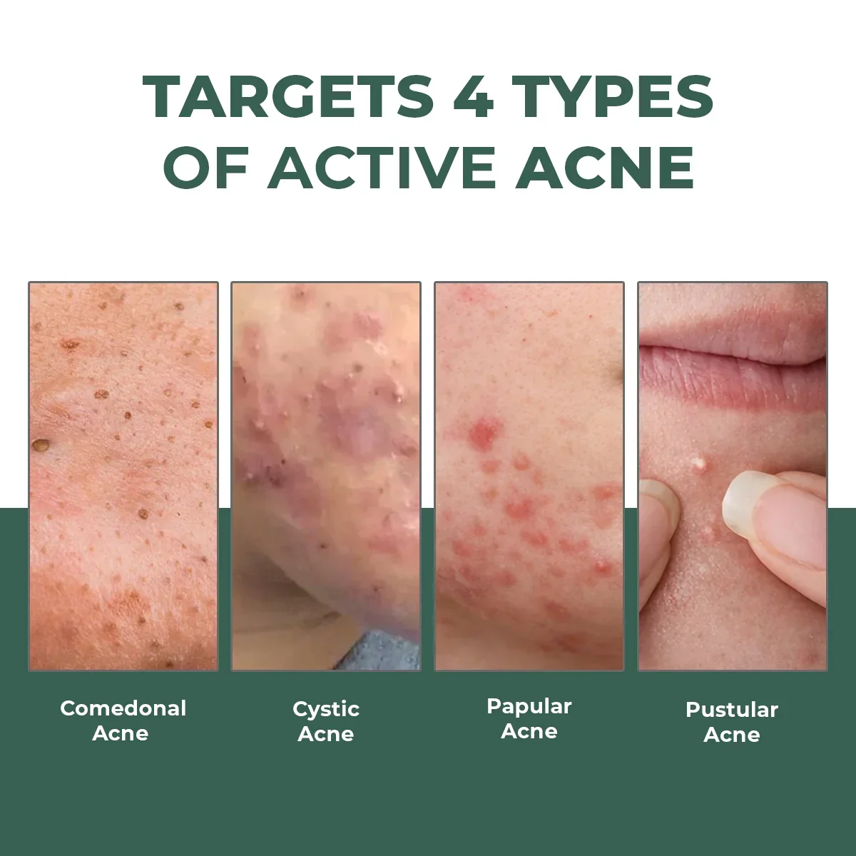 Acne Spot Corrector Gel | 15 ml | HP - Image 6