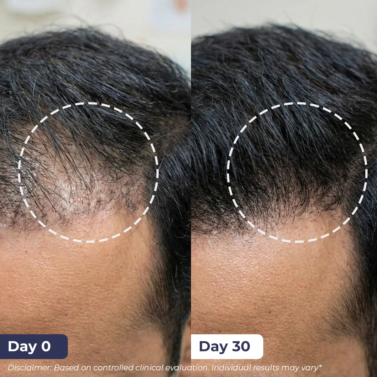 Advanced Hair Growth Kit | Oil + Shampoo + Conditioner + Spray + Serum | Reduces Hairfall & Boosts Hair Density - Image 6