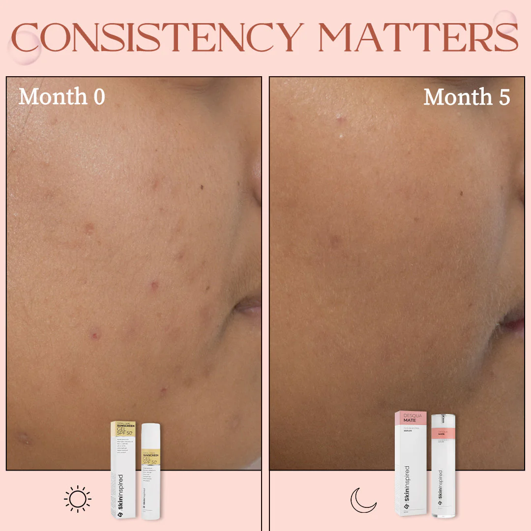 Aha Bha Pha Desqua Mate Face Serum | Salicylic Acid + Lactic Acid | Exfoliating Chemical Peel | Lasts 6 Months - Image 5