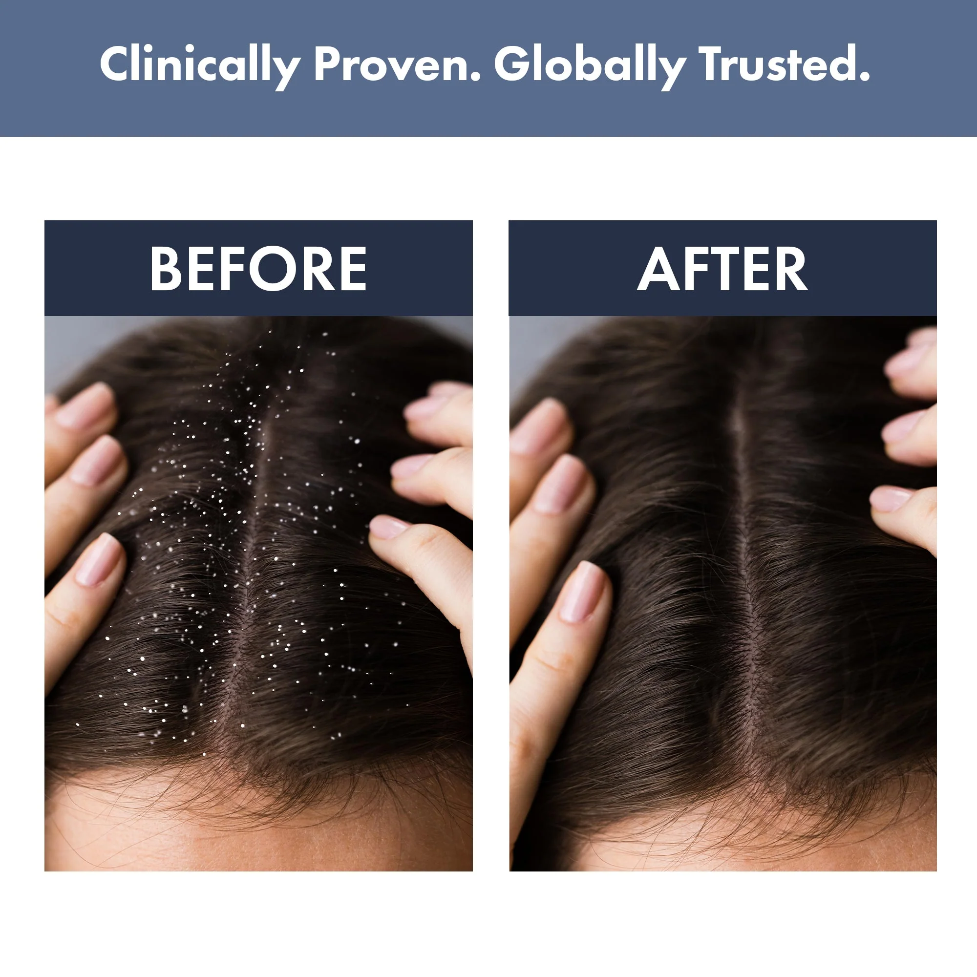 Anti-dandruff kit: Scalp Clear Shampoo + Anti Dandruff Serum - Image 5