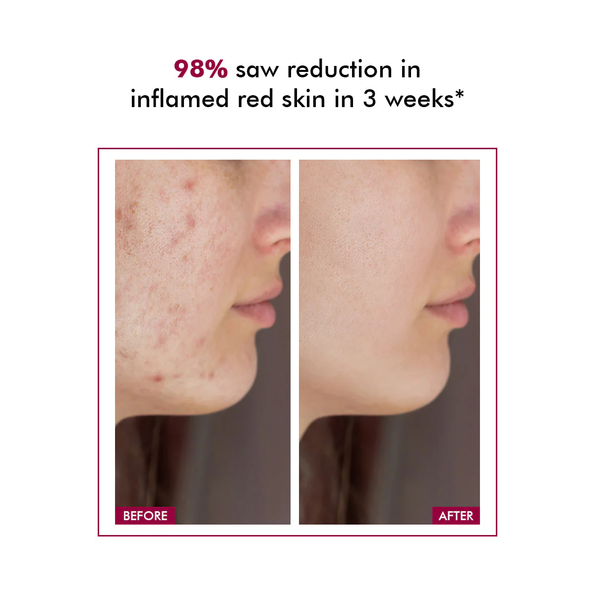 Azicalm Redness & Inflammation Relief Cream | 10% Azelaic Acid | 50 gms | AF - Image 3