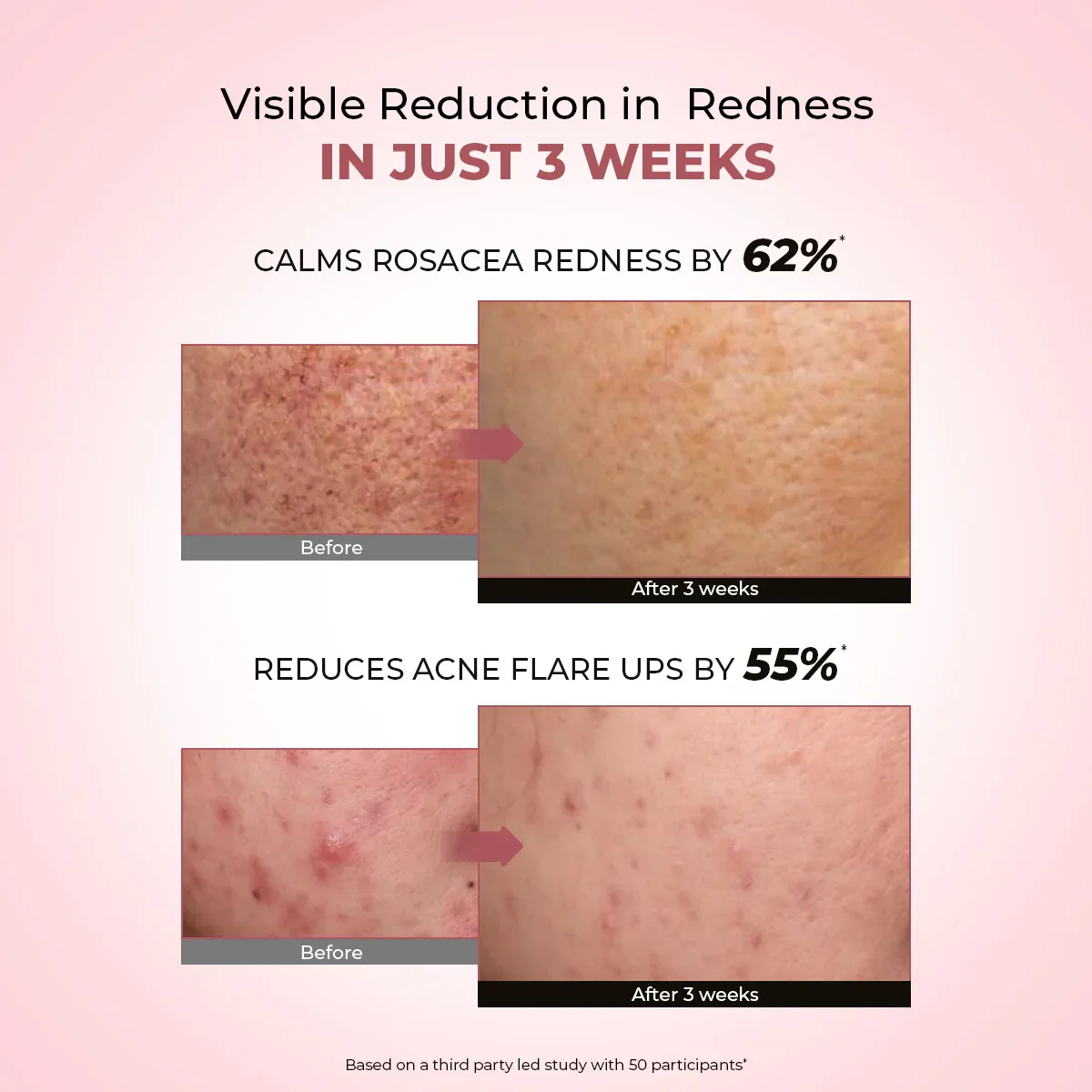 Azicalm Redness & Inflammation Relief Cream (Pack Of 2) |  10% Azelaic Acid | 2x50 gms - Image 4