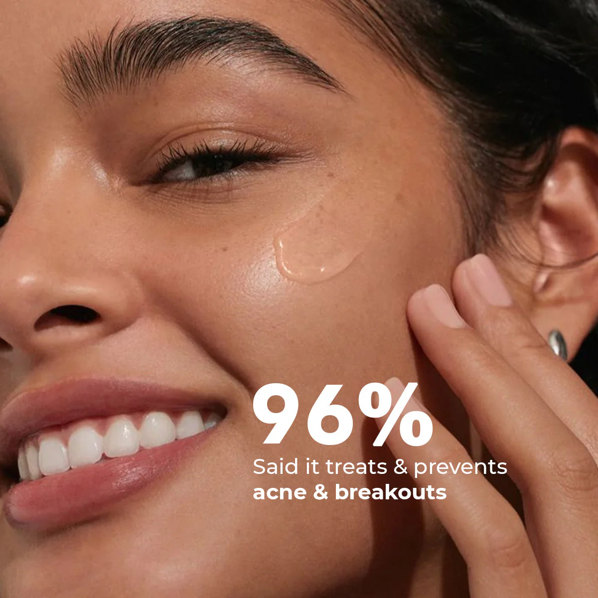 FlashFix Acne Treatment Serum | 2% Salicylic Acid & Willow Bark | 30 ml | BS - Image 2
