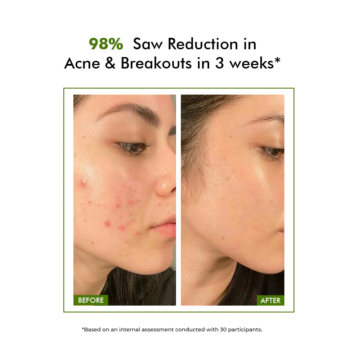 FlashFix Acne Treatment Serum | 2% Salicylic Acid & Willow Bark | 30 ml | BS - Image 4