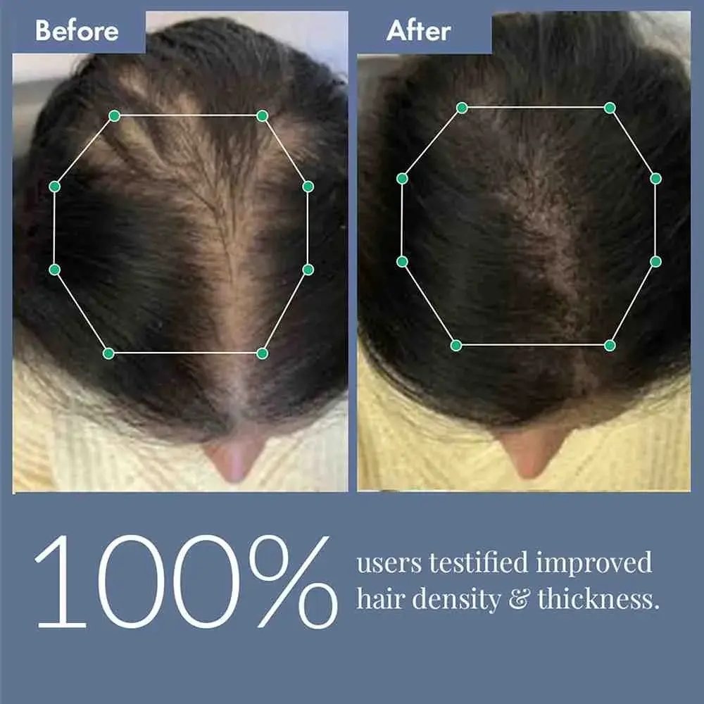 Hair Growth Serum 2.0 For Men & Women, 50ml + Free Rosemary Water Hair Spray, 100ml - Image 9
