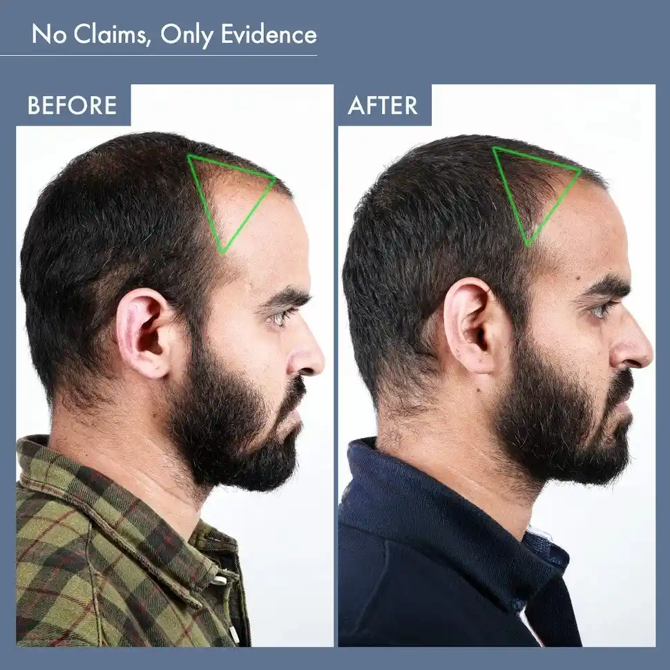 Hair Growth Serum, 50ml + Men's Hair Growth Supplement, 60N - Image 20