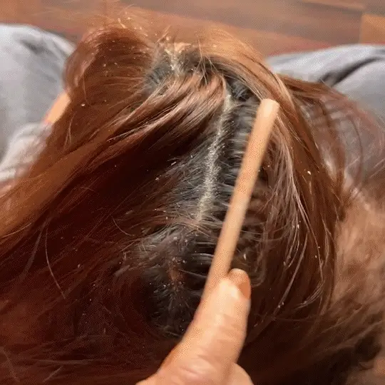 Instant Dandruff Removal Gel - Image 6