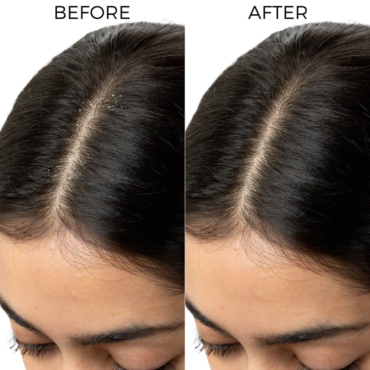 Lactylate Shampoo To Reduce Dandruff - Image 6