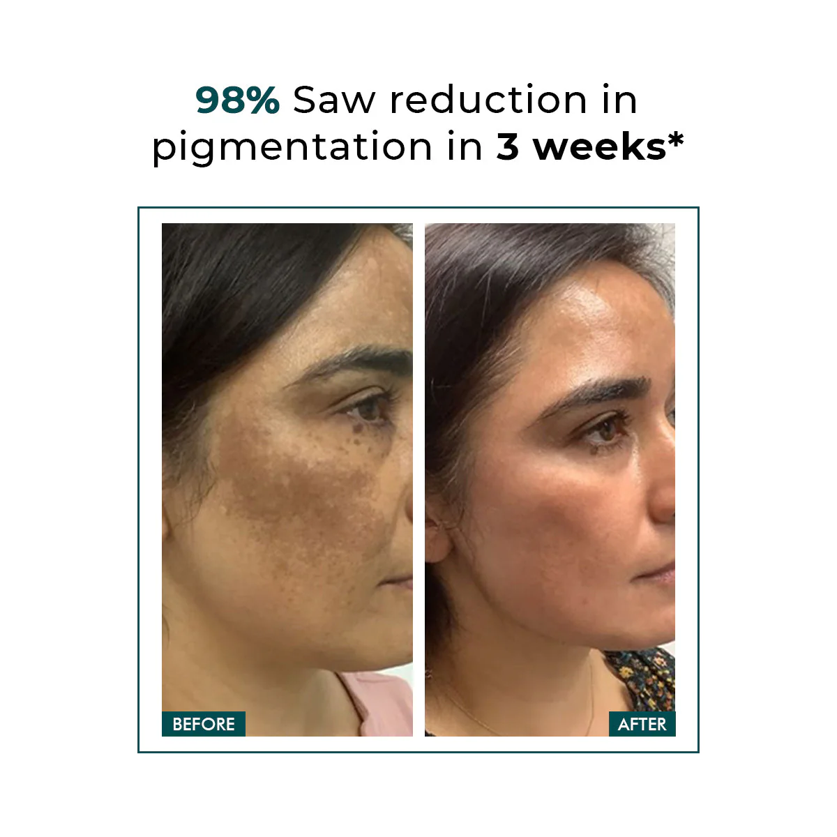 Pigmentation & Dark Spots Treatment | 5%  Niacinamide Serum | 30 ml - Image 4