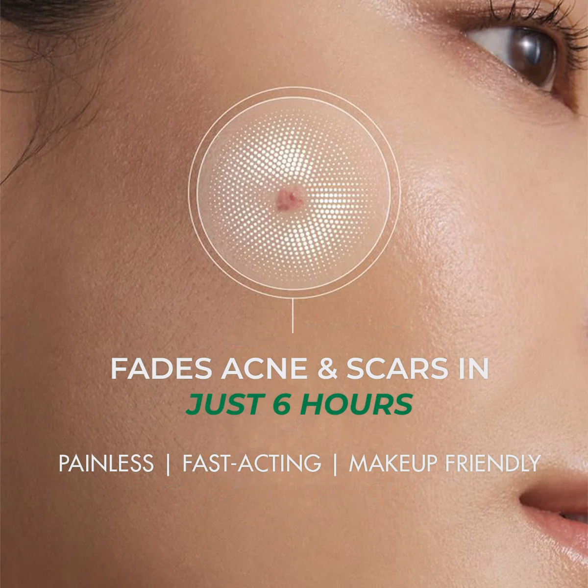 Self Dissolving Microneedle Acne Patches | 8 Patches | BS - Image 2