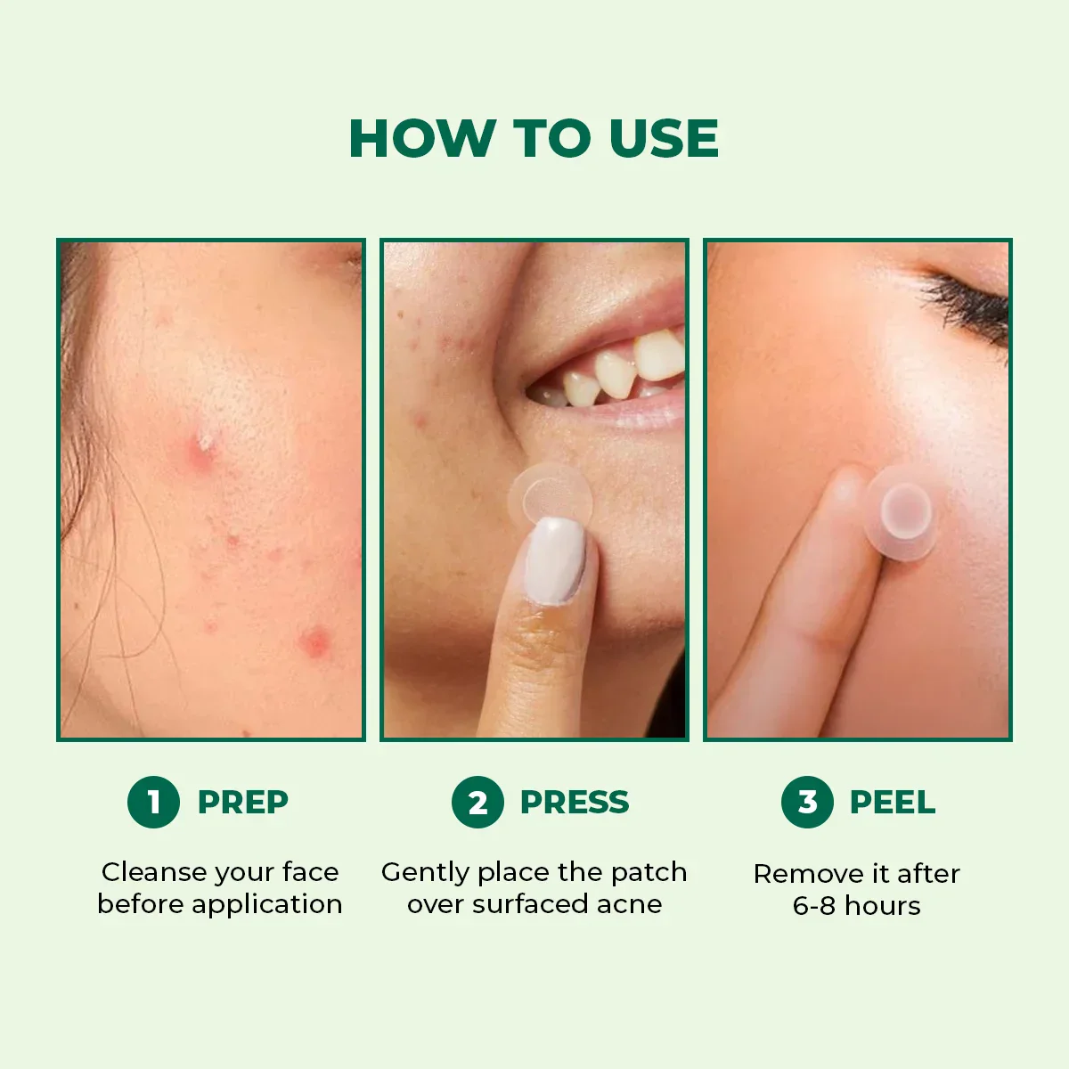 Self Dissolving Microneedle Acne Patches | 8 Patches | HP - Image 10