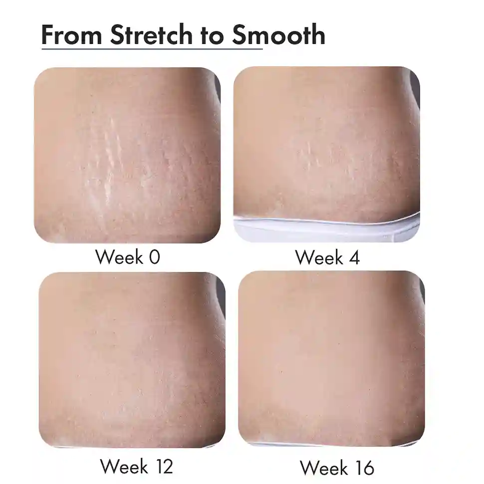 Stretch Marks Expert, Serum Cream, 30 ml - Image 13