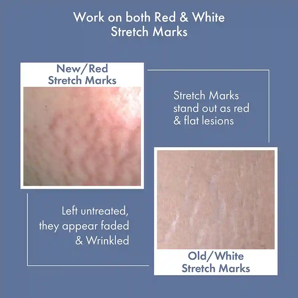 Stretch Marks Expert, Serum Cream, 30 ml - Image 6