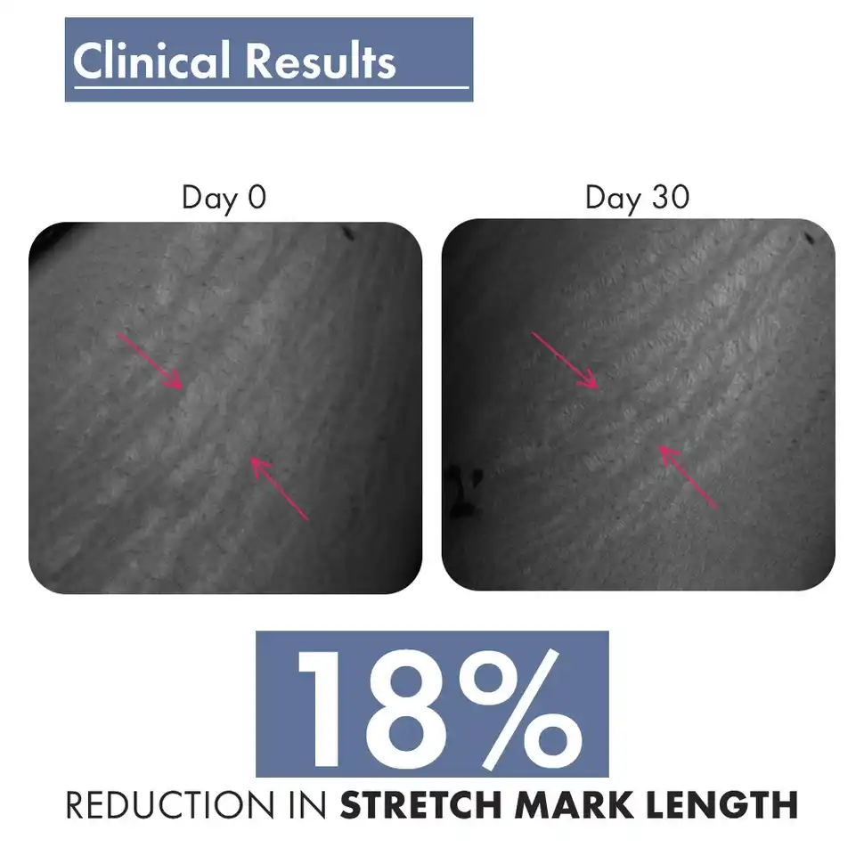 Stretch Marks Expert, Serum Cream, 30 ml - Image 8